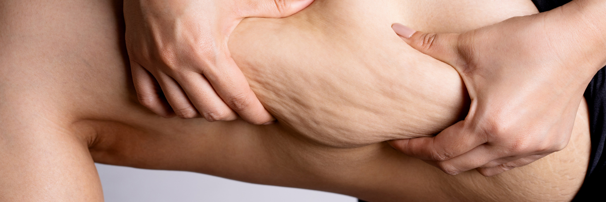 Cellulite