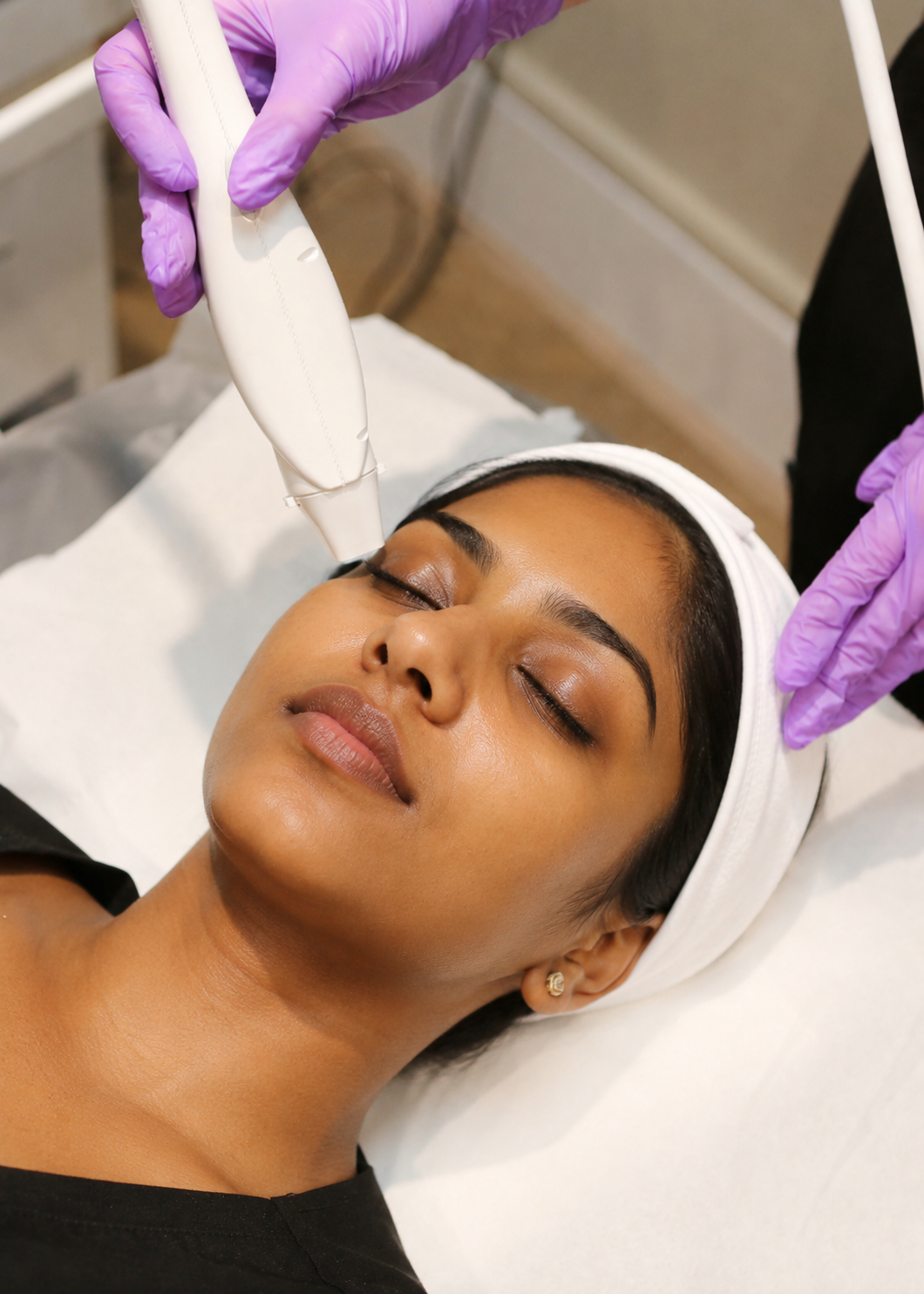 rf microneedling birmingham