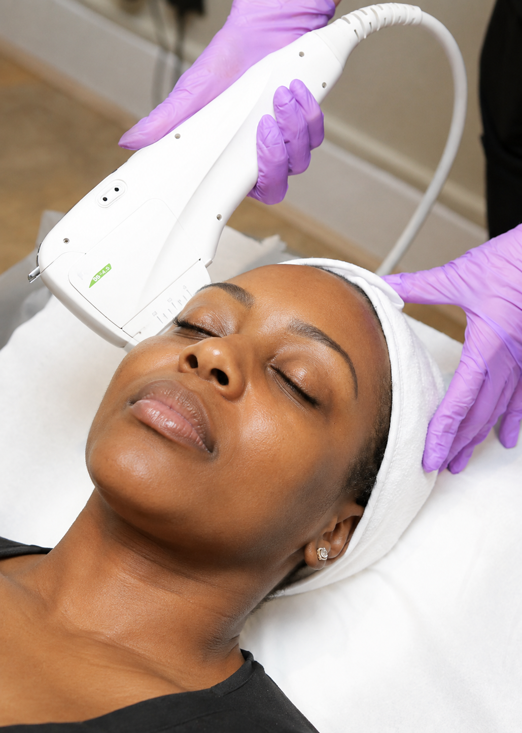 HIFU non-surgical facelift treatment in Birmingham