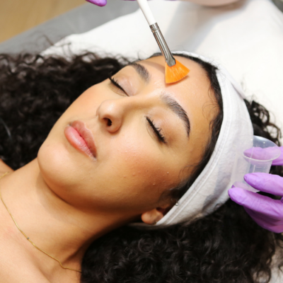 Chemical Peels