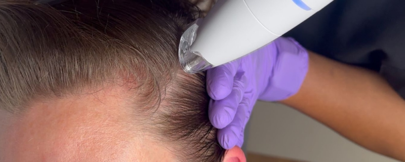 microneedling with exosomes for hair loss birmingham