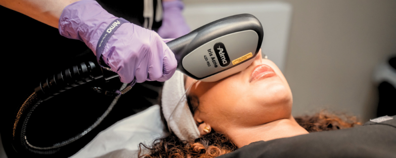 IPL acne treatment in Birmingham