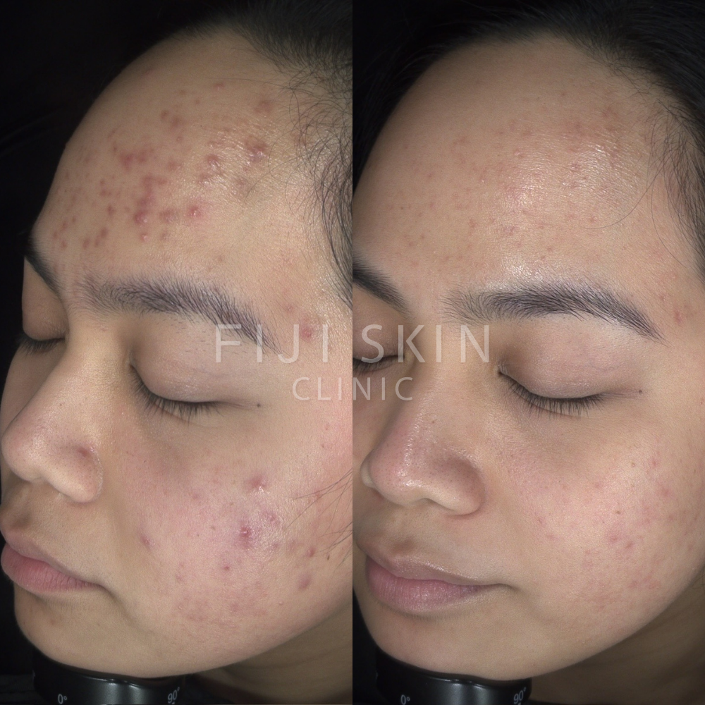 acne and breakout before and after fiji skin clinic asian skin brown skin