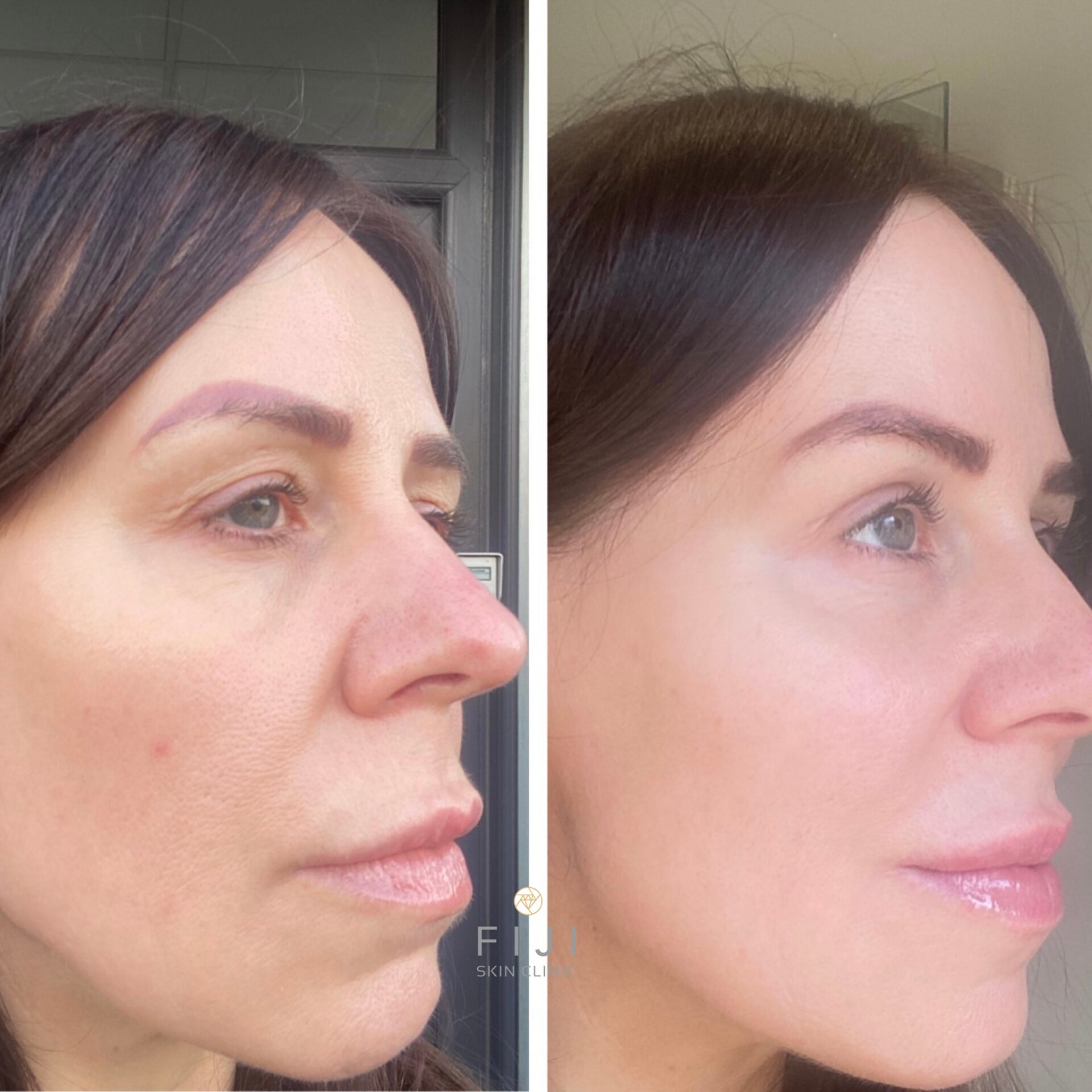 lemon bottle fat dissolving vs kybella HIFU Versus Fat Dissolving Injections such as Lemon Bottle Fat Dissolving &  Aqualyx